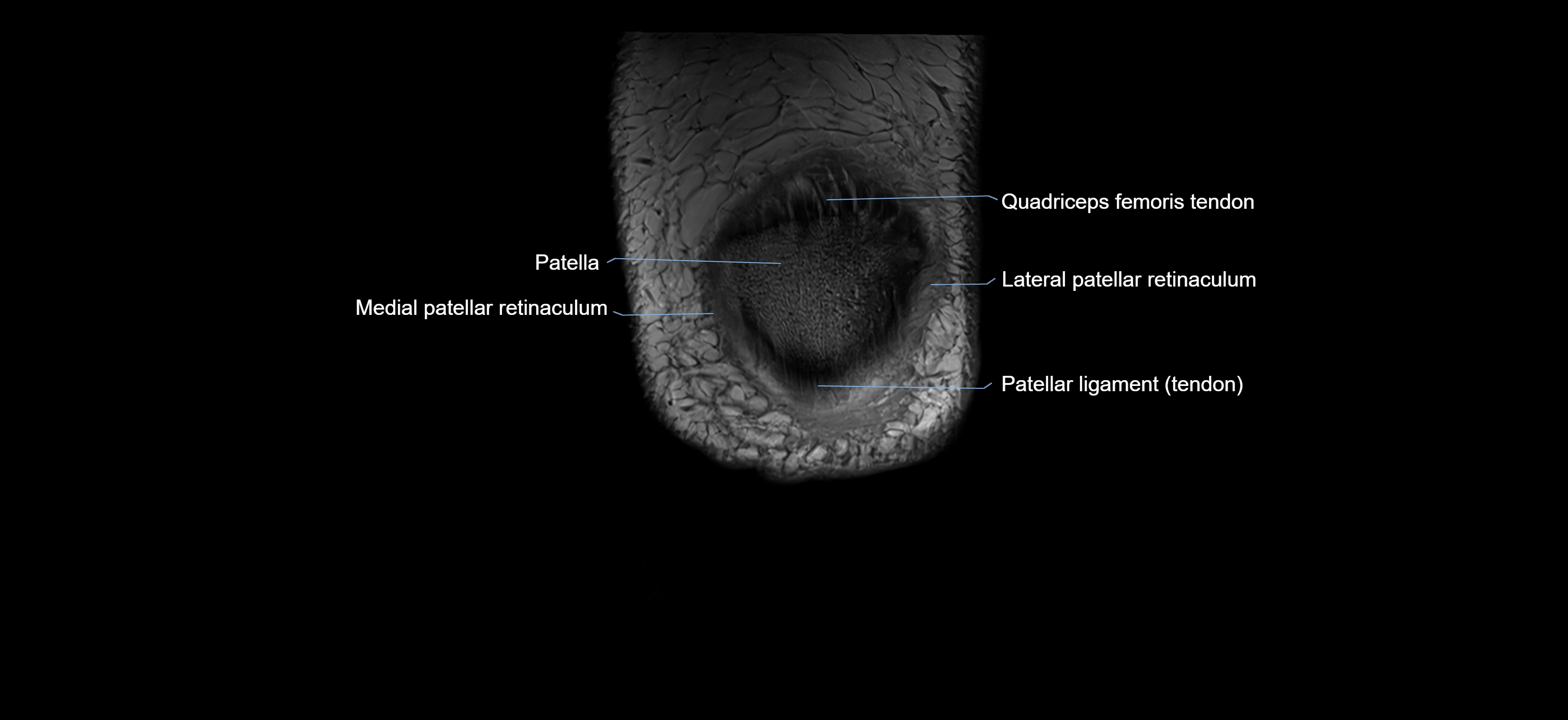 MRI knee coronal cross sectional anatomy labelled 3T radiology  image-04001-00003.webp